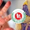 হাম উপসর্গে আরও ৩ মৃত্যু